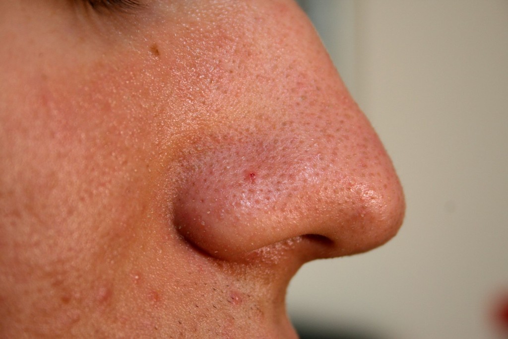 Nose_with_Blackhead_2009